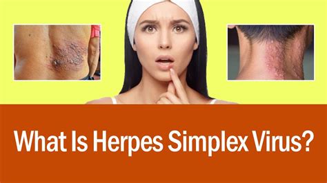 What Is Herpes Simplex Virus | Signs And Symptoms| How To Cure Herpes ...