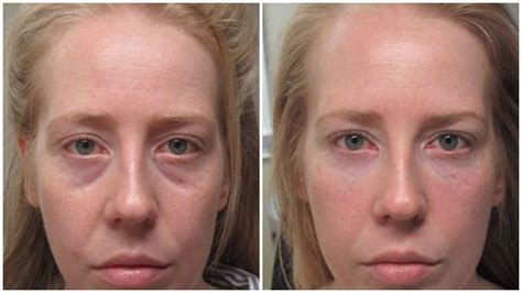 Incredible Tear Trough/Under Eye Filler Results! | Under eye fillers ...