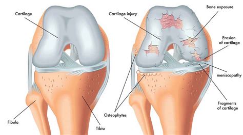 Crepitus meaning, causes & treatment