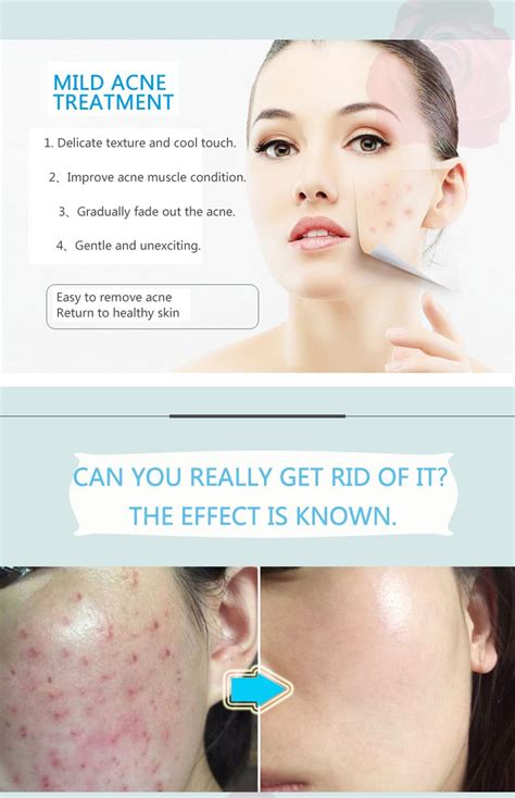 Acne marks removal cream | Acne mark removal, Acne marks, Skin