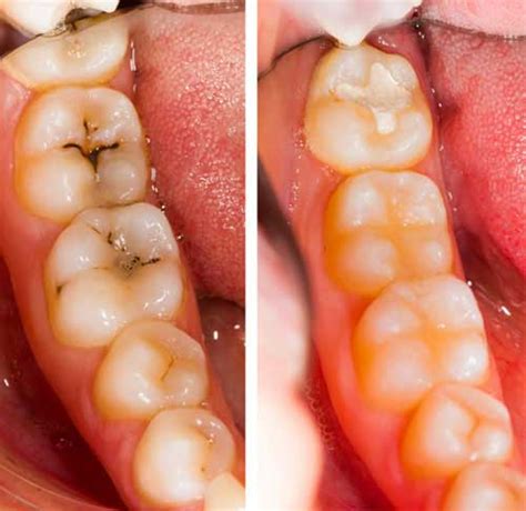 Tooth Decay Molar Treatment