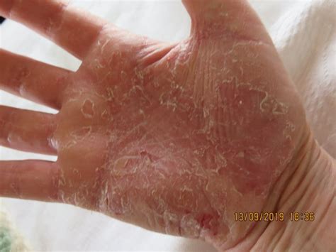 Acitretin Side Effects Psoriasis (PICTURES And REVIEW) – PSORIASIS ...