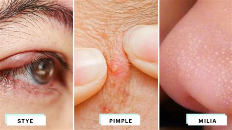 Discover more than 73 pimple under eye bag latest - in.cdgdbentre