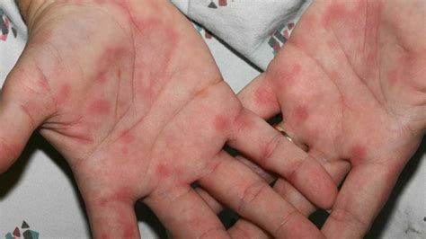 Types of rashes on palms