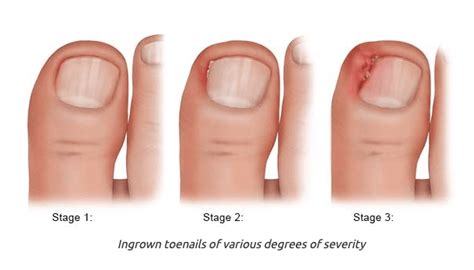 1 - Best Ingrown Toenail Surgery Cambridge | An Ingrown Toenail Is One ...