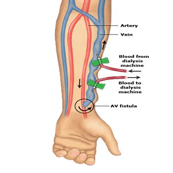 AV FISTULA/ AV ACCESS Treatment in Pune | Dr. Harshawardhan Oak