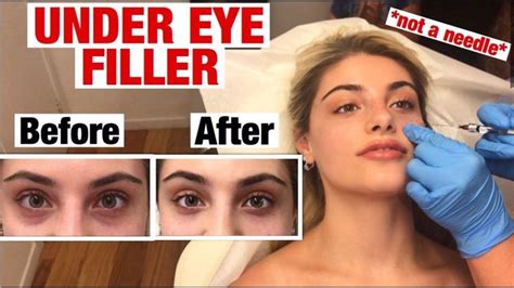 UNDER EYE FILLER INJECTION for dark circles and bags!! Before & After # ...