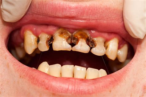 What Are Dental Cavities? Symptoms, Causes And Treatment