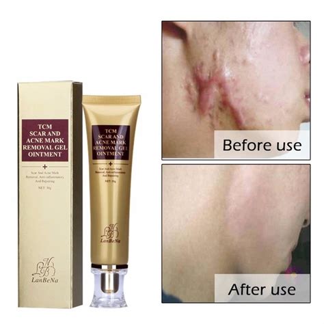 TCM SCAR AND ACNE MARK REMOVAL GEL OINTMENT (30g) Acne Scar Cream