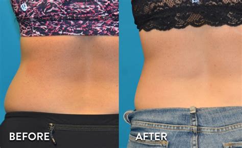 SculpSure Before and After Pictures | SculpSure Photo Gallery