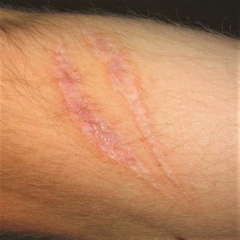 About Scars - Burn Survivor