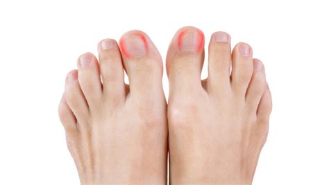 How To Treat Infected Ingrown Toenail