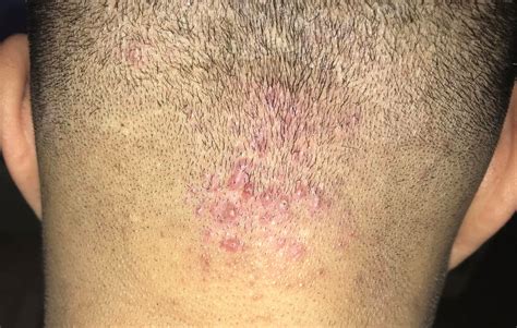 Folliculitis Scalp