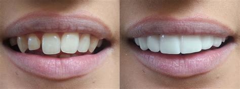 Veneers: What’s in a Beautiful Smile? - Hutto Hippo