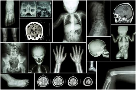 Brittle Bone Disease : Overview, Causes, Symptoms, Treatment - illness.com