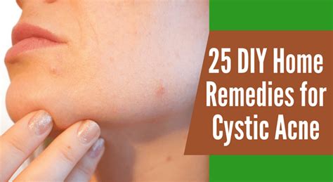 25 DIY Home Remedies for Cystic Acne Treatment – Wellness.guide