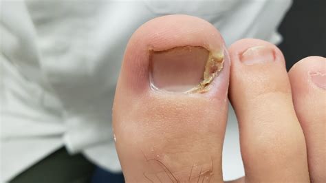 How to treat an ingrown toenail explained.