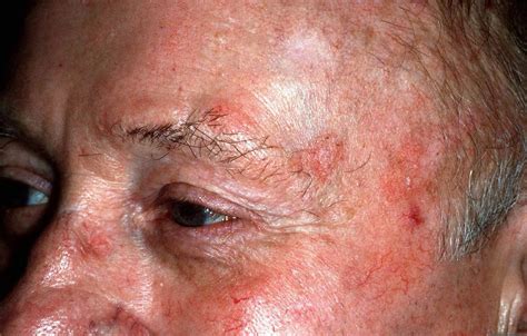 Actinic Keratosis Melanoma Seborrheic Keratosis On Stock Foto | The ...