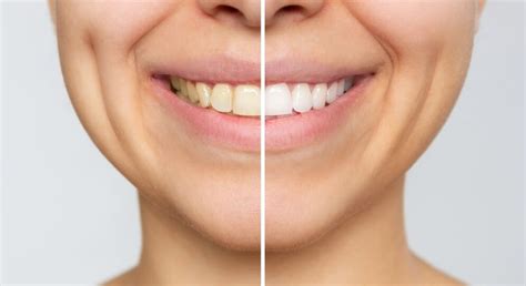 How Teeth Whitening Can Transform Your Smile For World Smile Day ...