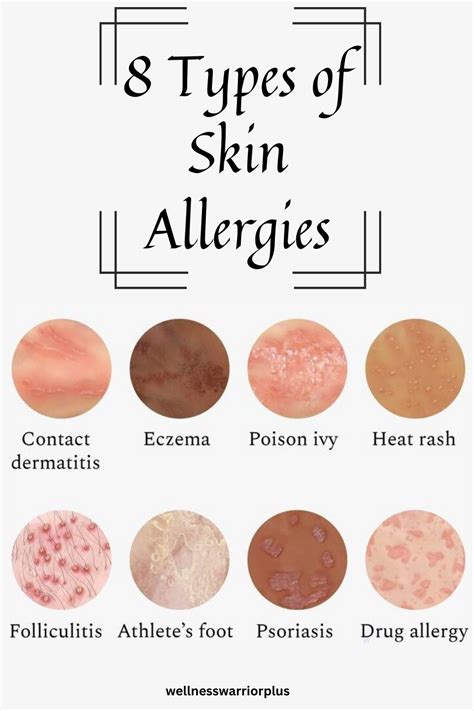 8 Types of Skin Allergies in 2024 | Skin allergies, Allergies, Skin rash