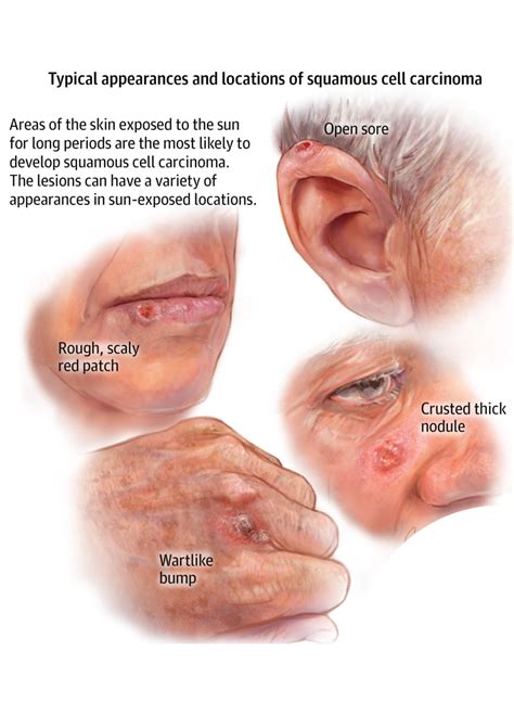 Basal Cell Carcinoma - Richmond Hill Cosmetic Clinic