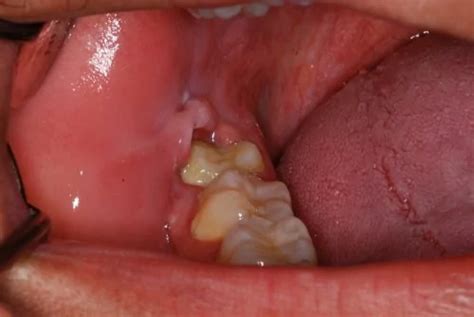 Blog - wisdomteeth