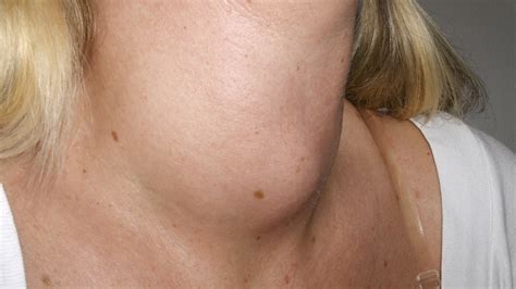 goiter on thyroid - Deanne Stageman