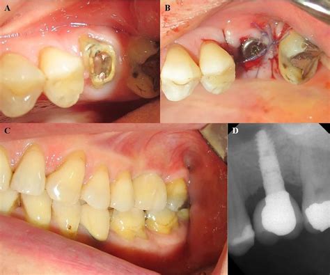 (A) Hopeless maxillary first molar which is planned to be extracted ...