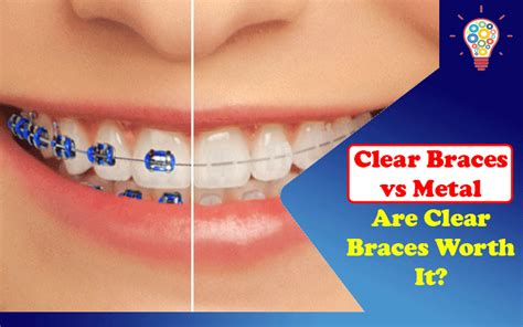 Clear Braces Vs Metal: Are Clear Braces Worth It? - Updated Ideas