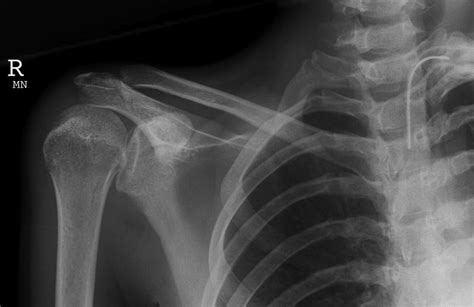 Posterior Shoulder Dislocation • LITFL • Trauma Library