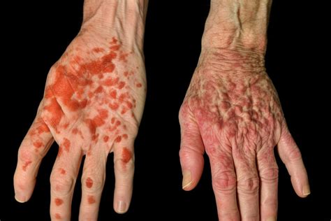 Psoriasis Vs Eczema: The Key Differences You Need To Know by Leo Hayes