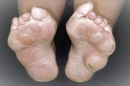 Lump Or Bump On Bottom Of Foot: Causes, Symptoms & Treatment