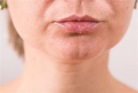 Why Do I Get Pimples Under My Lower Lip | Sitelip.org