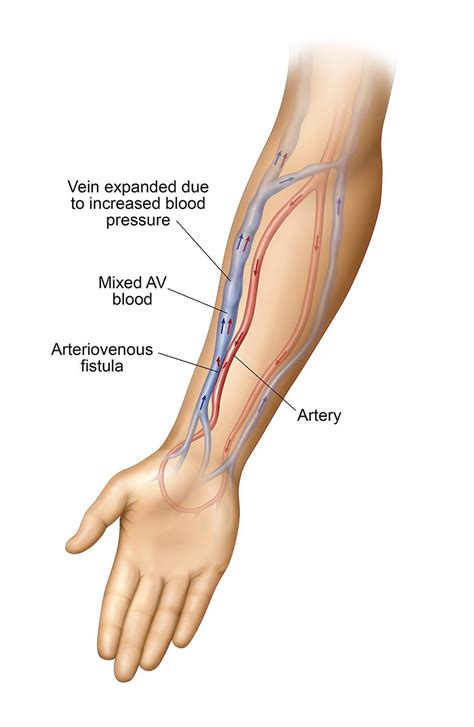 What Does a Healthy AV Fistula Look Like? | Azura Vascular Care