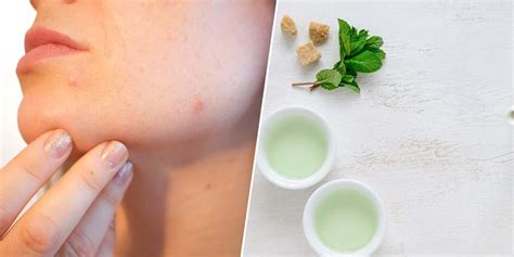 Here Is How Green Tea Solves Acne Problems!-Here Is How Green Tea ...