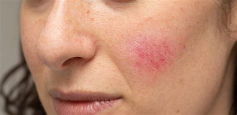 Rosacea: symptoms, causes and treatment