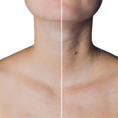 How To Get Rid Of Tech Neck? Micro-Botox is Here to Help! — Urban You ...