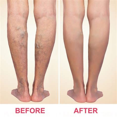 Varicose Veins Treatment Mumbai | Dr. Jathin's Vein Center