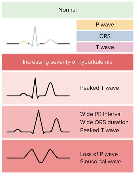 Hyperkalemia (Clinical) | Concise Medical Knowledge