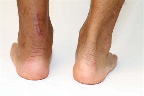 40+ Achilles Tendon Scar Stock Photos, Pictures & Royalty-Free Images ...