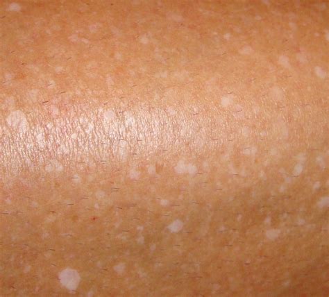 Why Do I Have White Spots On My Legs After Tanning - Printable ...