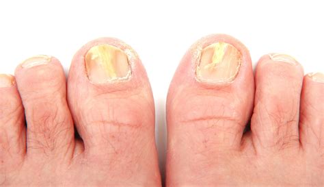 Top 11 Toenail Fungus Natural Treatments Using Home Remedy