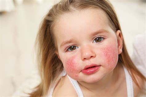 Can Your Children Get Allergy Hereditarily?