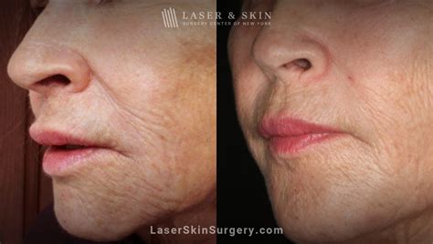 Expert Dermatologists Name 8 Best Lasers and Devices for Skin ...