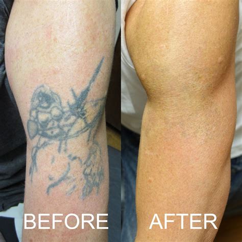 What Is Involved With Tattoo Relief? – MD Chat