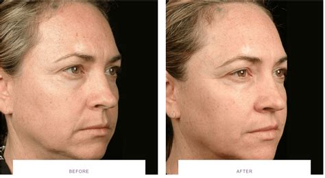 Laser Skin Tightening before and after - Thermage, Morpheus8, Ultherapy ...