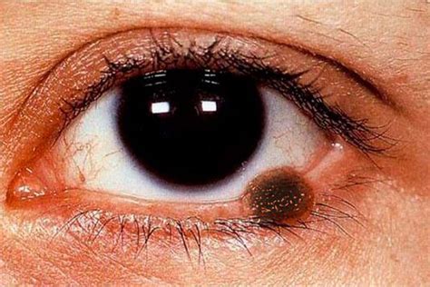 Melanoma Eyelid