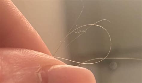 White, Hair-like Fibers Found All Over Body Causes Concern for This ...