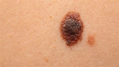 Black Mole Melanoma Skin Cancer