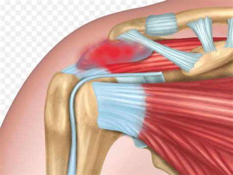 Inflamed Shoulder Tendons